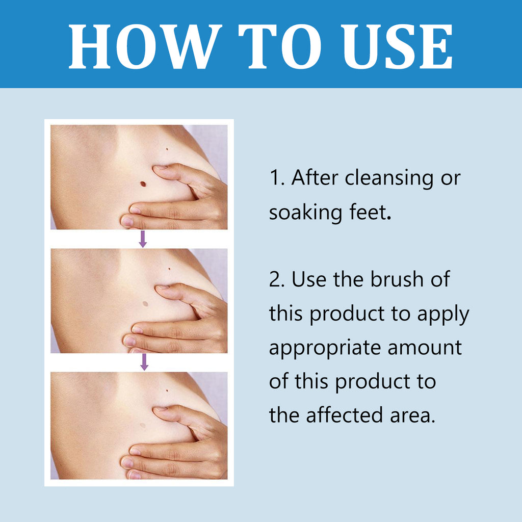 Ximonth Quick Liquid, Brothers, Warts Corns Moles Skin Proud Flesh Smooth Skin Clean And Care
