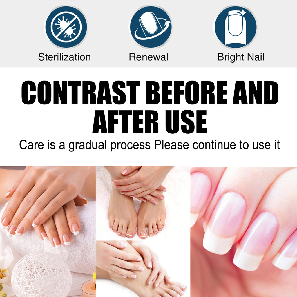South Moon Exstroyeza Pen, Hand And Foot Gray Nail Repair Gray Nail Solution Thickening Nutritional Repair Solution