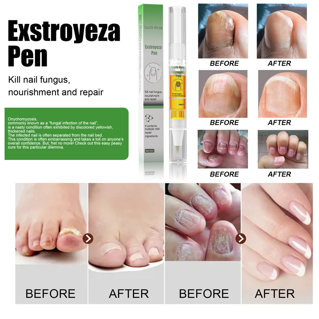 South Moon Exstroyeza Pen, Hand And Foot Gray Nail Repair Gray Nail Solution Thickening Nutritional Repair Solution