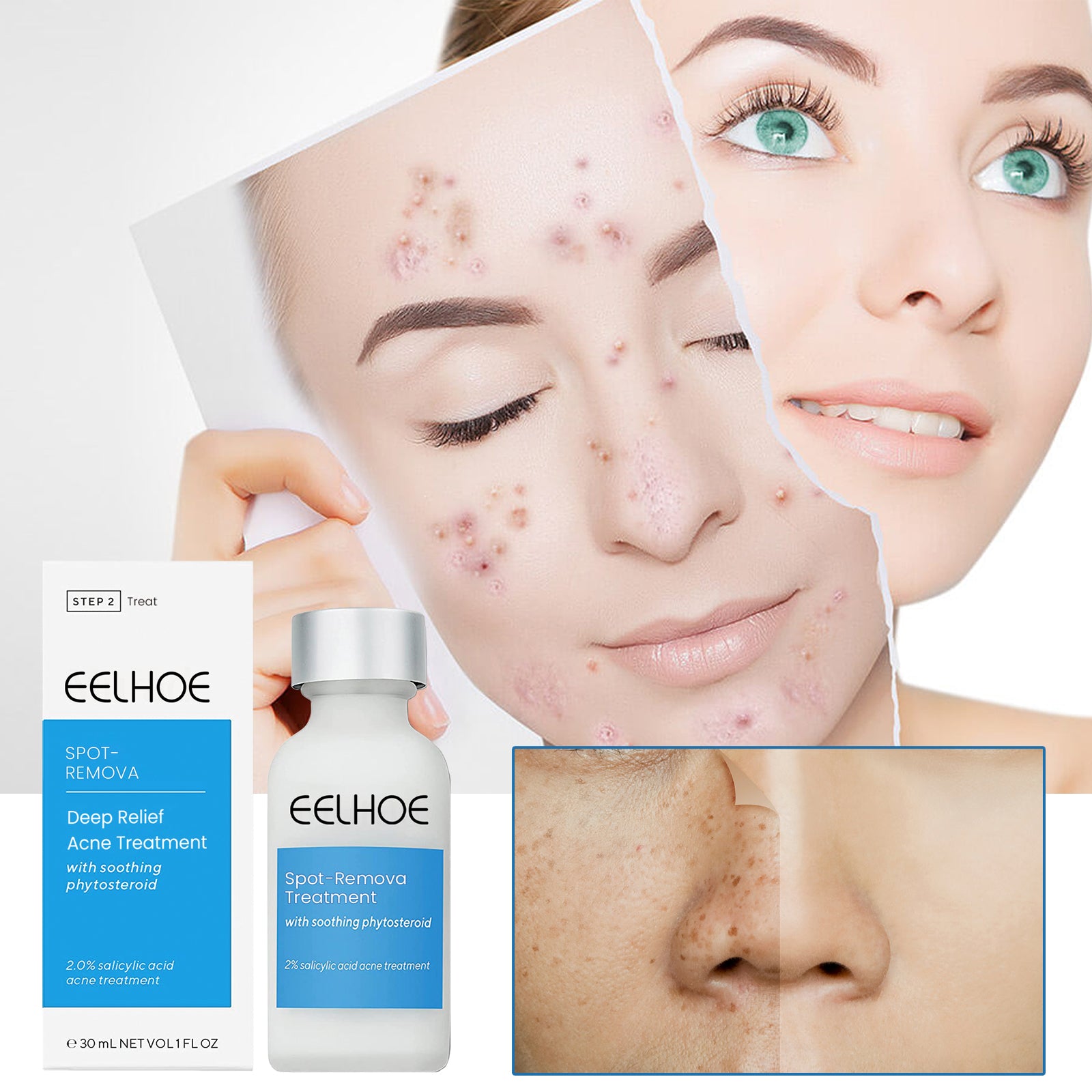 EELHOE Blemish Smoothing Lotion, Reduce Closed Mouth Acne Acne Spot Removal Repair Skin Lotion