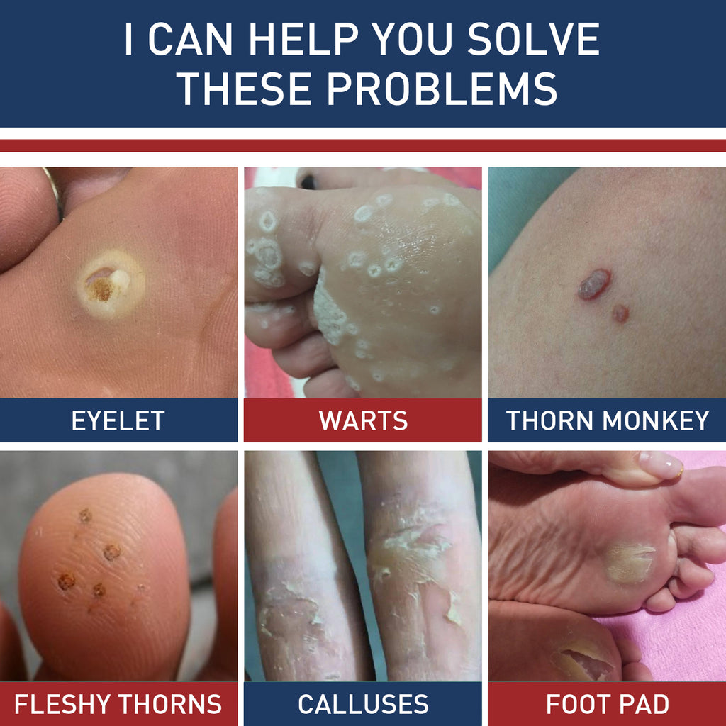South Moon Gram Warty Corns Patch, Foot Soles Chicken Especially Clean Flesh Piercing Wart Wart Repair Patch Plain Sweat Tube Repair Patch