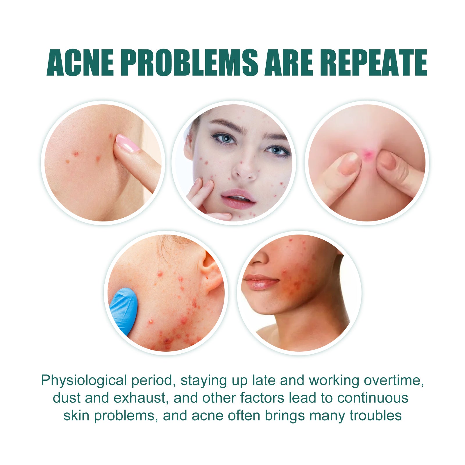 EELHOE Star Acne Patch Gentle Cleansing Lighten Acne Soothing Skin Acne Patch Facial Cleansing Treatment